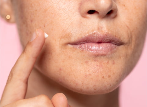 Do you have dark spots on your skin? Discover their causes and how to  reduce them