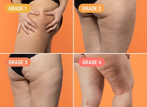 Hard Cellulite: What Is It and How to Get Rid of It